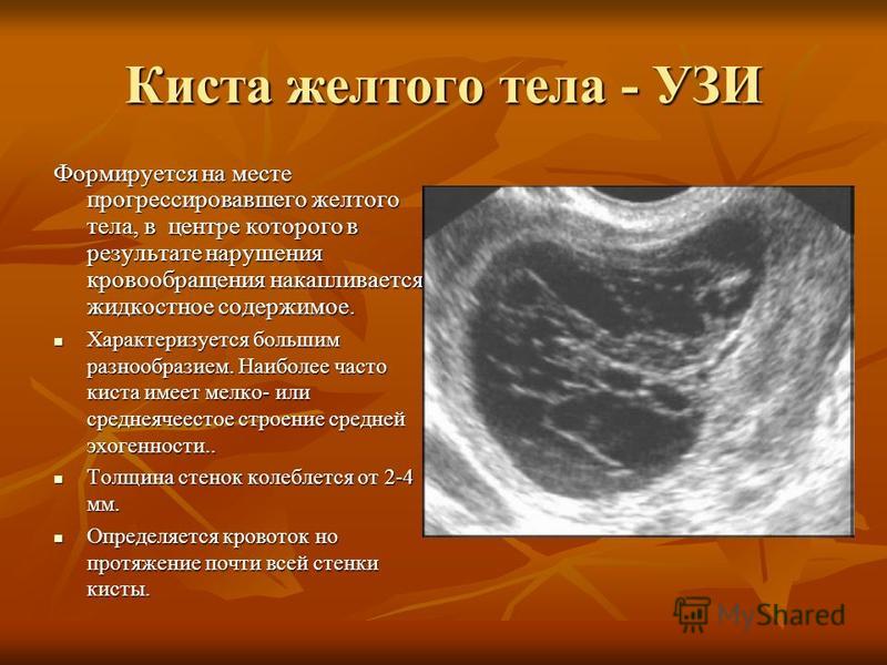 Беременость с кистой Беременость с кистой