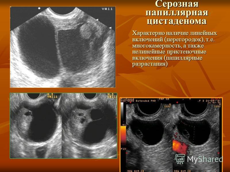Цистаденома яичника что это такое и как лечить Цистаденома яичника что это такое и как лечить