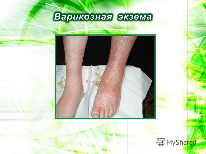 Заболевание связанные с вич Заболевание связанные с вич