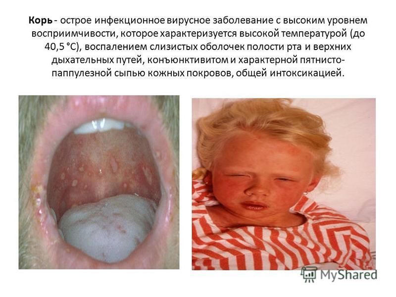 Корь у ребенка симптомы фото