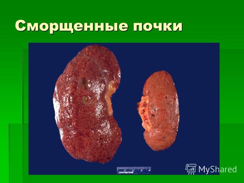 здесь были чем опасен пиелонефрит почек выпуска автомобиля линию