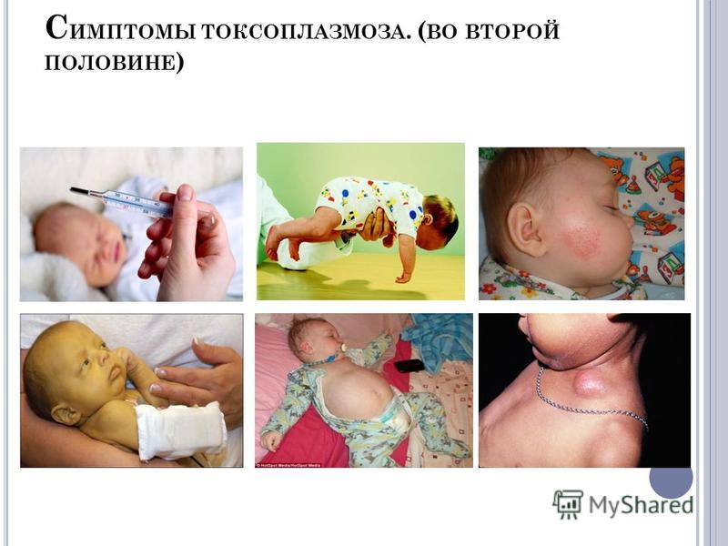 Токсоплазмоз симптомы у беременной 11