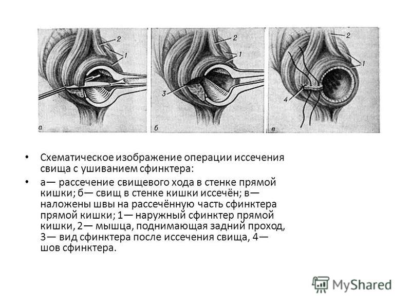 Диета После Иссечения Свища Прямой Кишки