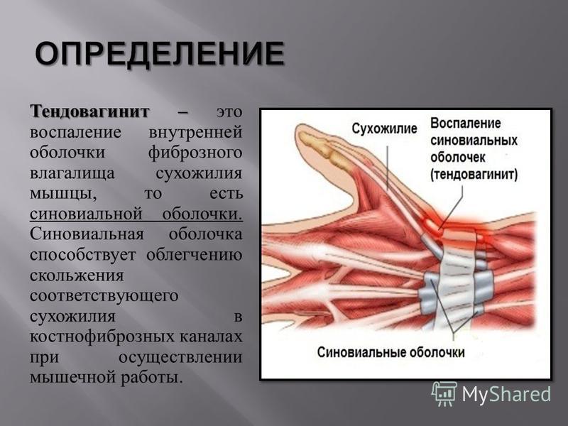 Болит поясница отдаёт в правую ягодицу Болит поясница отдаёт в правую ягодицу