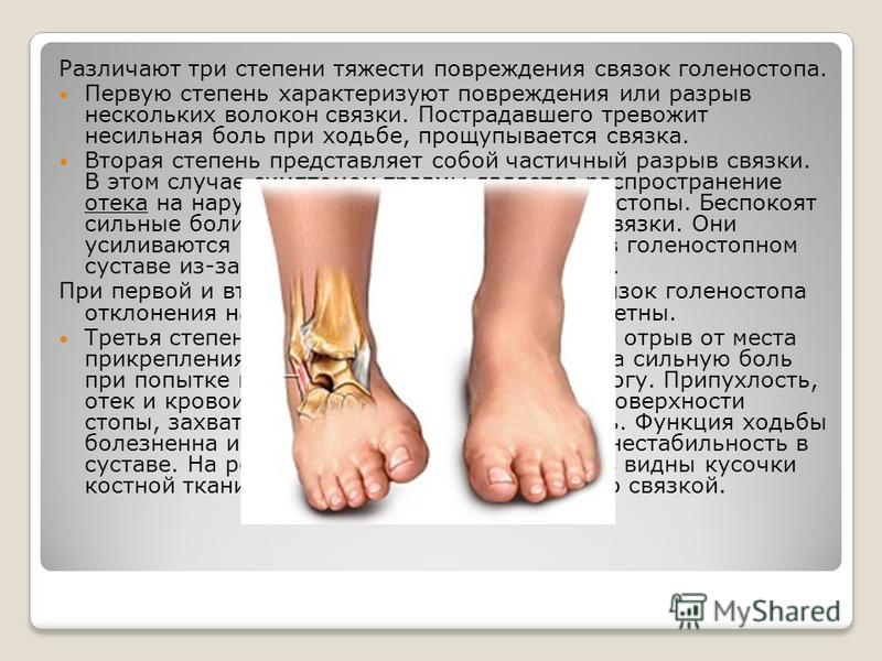 Что если ходить с растяжением связок Что если ходить с растяжением связок