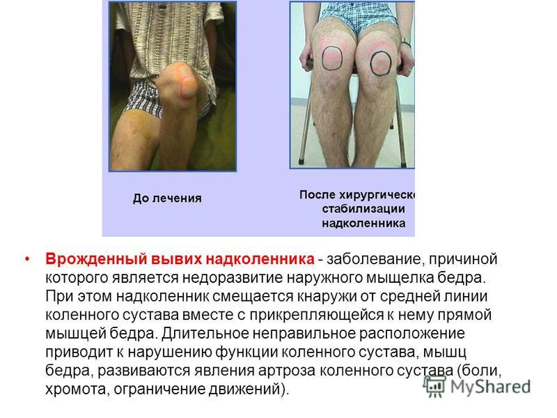 Физиологически незрелые суставы Физиологически незрелые суставы