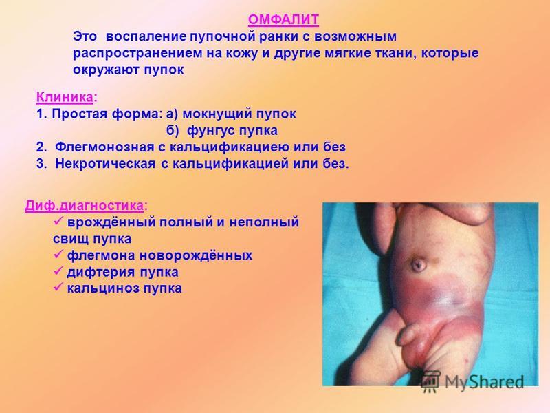 Заболевания кожи и пупка у новорожден Заболевания кожи и пупка у новорожден