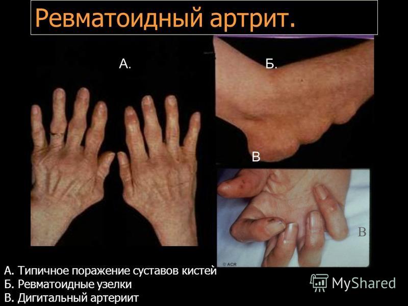 Воспалившийся шейный остеохондроз Воспалившийся шейный остеохондроз