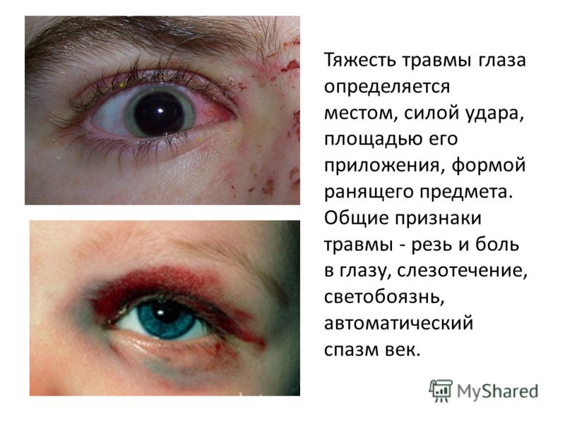 Тяжесть травмы глаза определяется местом, силой удара, площадью его приложения, формой ранящего предмета. Общие признаки травмы - резь и боль в глазу,