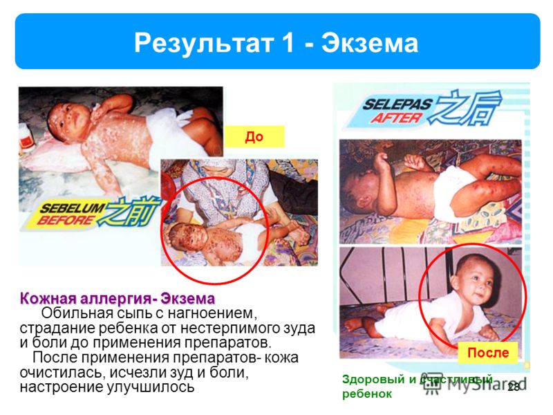 Анти псориаз препарат