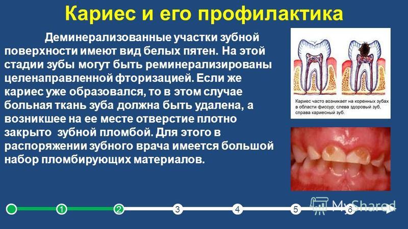 Кариес это заболевание зубов Кариес это заболевание зубов