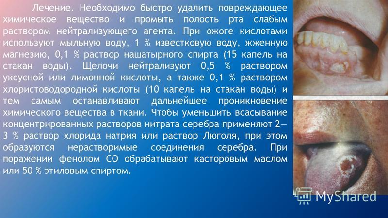Как лечить ожог полости рта в домашних условиях Как лечить ожог полости рта в домашних условиях