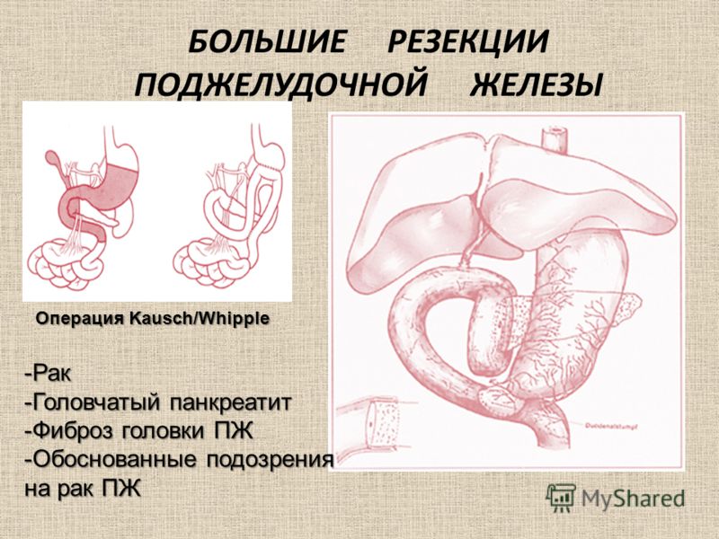Как снять боль при коксартрозе 4 степени