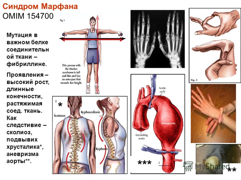 Синдром Марфана - Причины, симптомы и лечение. Журнал 90 Синдром Марфана - Причины, симптомы и лечение. Журнал 20