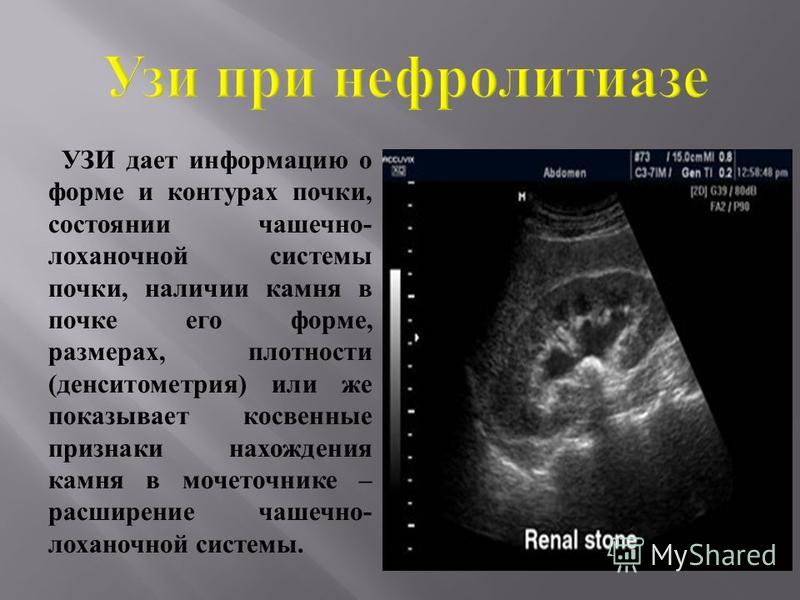 Камень в правой почке у беременной 58