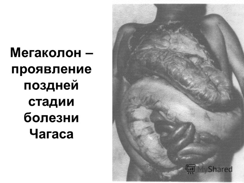 проявления паразитов в организме проявления паразитов в организме