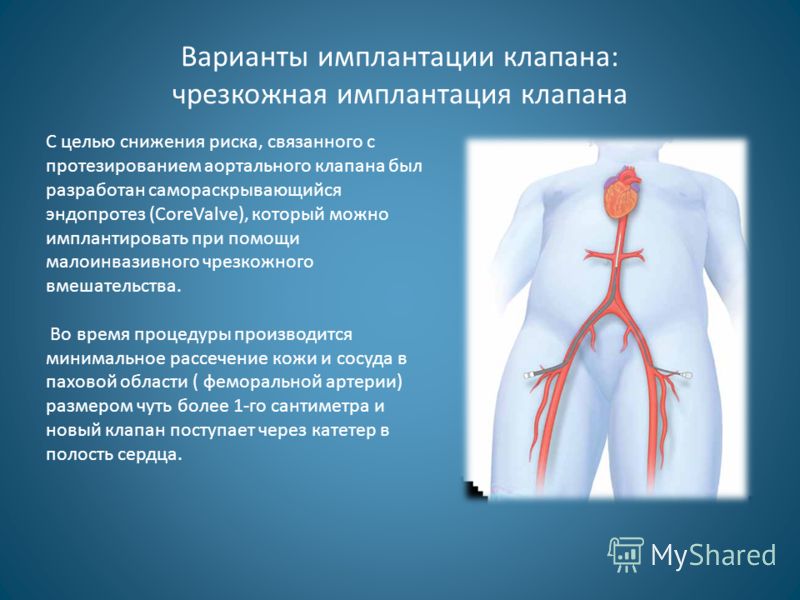 Связанные с аортальным клапаном Связанные с аортальным клапаном