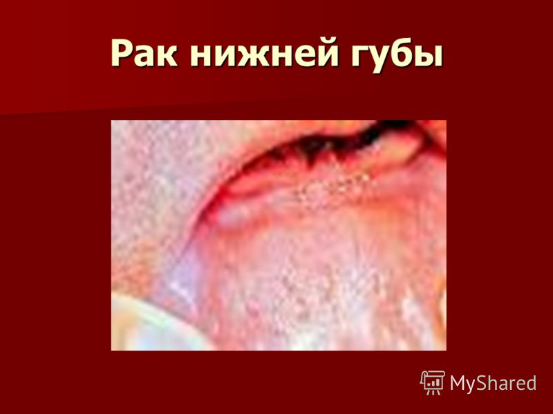 Рак нижней губы