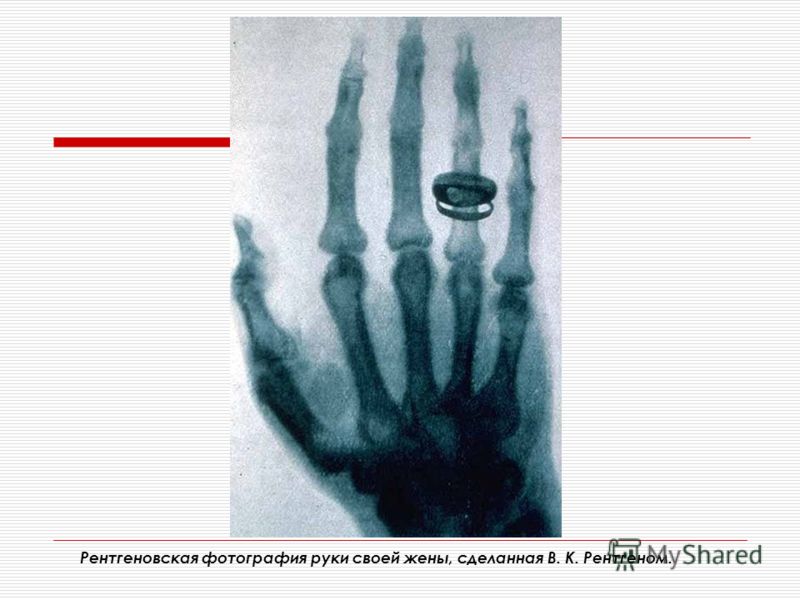 Рентгеновская фотография руки своей жены, сделанная В. К. Рентгеном.