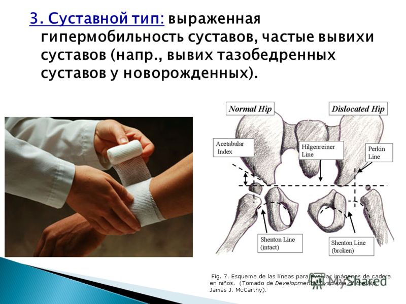 Алкоголь влияние на суставы Алкоголь влияние на суставы
