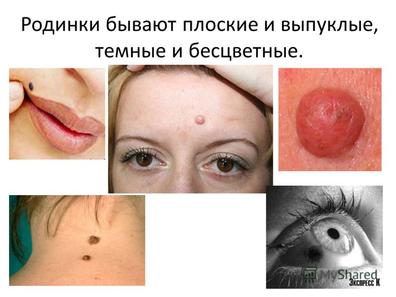 Можно ли папилломы прижигать чистотелом