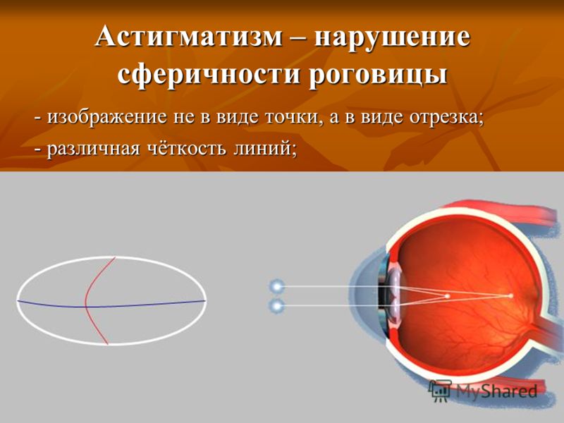 Гомеопатия для лечения близорукости у детей