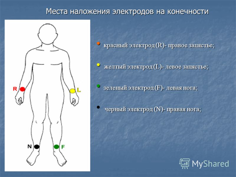 фото экг наложение электродов онлайн фото экг наложение электродов