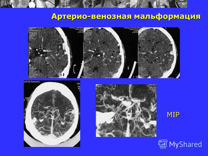 Микардин диета и вес