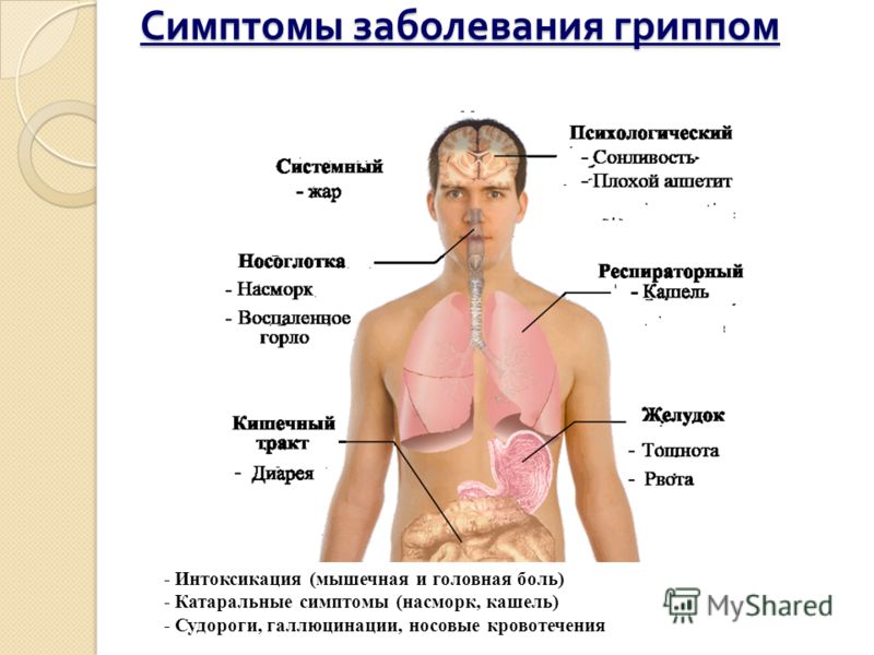 Симптомы заболевания гриппом - Интоксикация (мышечная и головная боль) - Катаральные симптомы (насморк, кашель) - Судороги, галлюцинации, носовые кровотечения