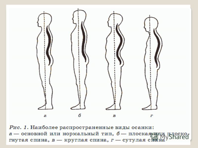 Исправление сколиоза корсет