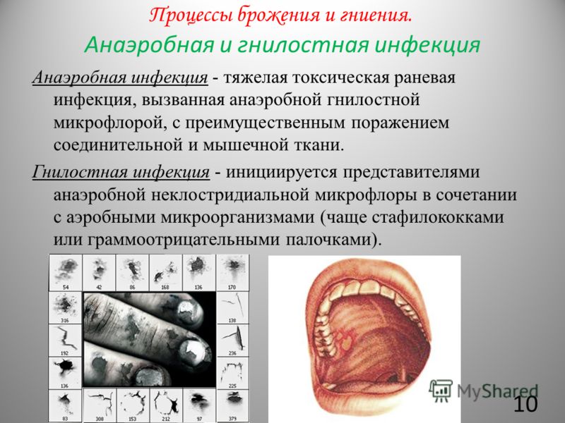 Реферат Анаэробная Инфекция