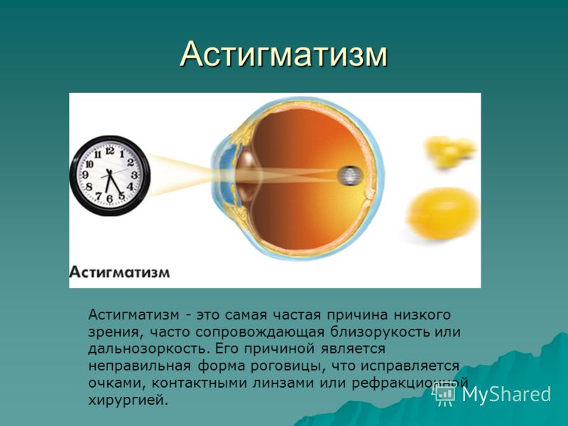 Киров лазерная коррекция зрения цены