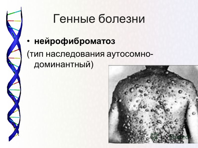Хромосомные заболевания человека связанные с аутосомами Хромосомные заболевания человека связанные с аутосомами