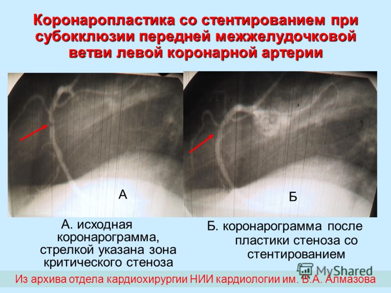 Диета После Стентирования Коронарных