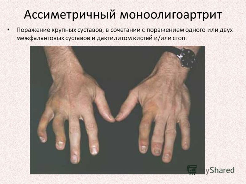 Артрит определение вида симптомы и лечение народными средствами