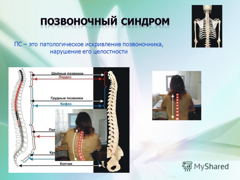 Плоскостопие и правильная осанка