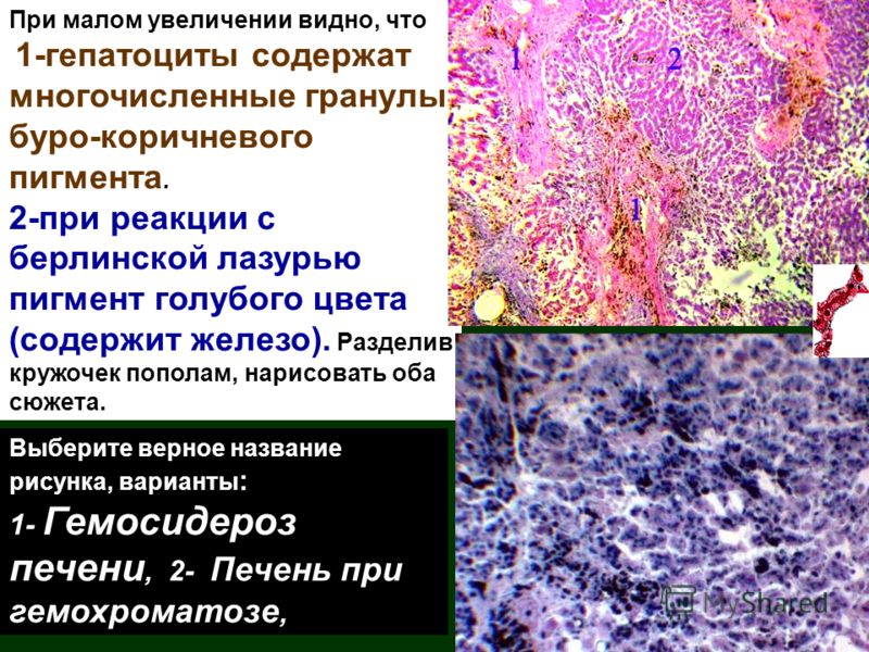При малом увеличении видно, что 1-гепатоциты содержат многочисленные гранулы буро-коричневого пигмента. 2-при реакции с берлинской лазурью пигмент голубого цвета (содержит железо). Разделив кружочек пополам, нарисовать оба сюжета. Выберите верное наз