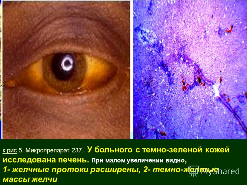 ЛЕКЦИЯ 5. Гнойничковые заболевания кожи Признаки (симптомы) рака молочной железы