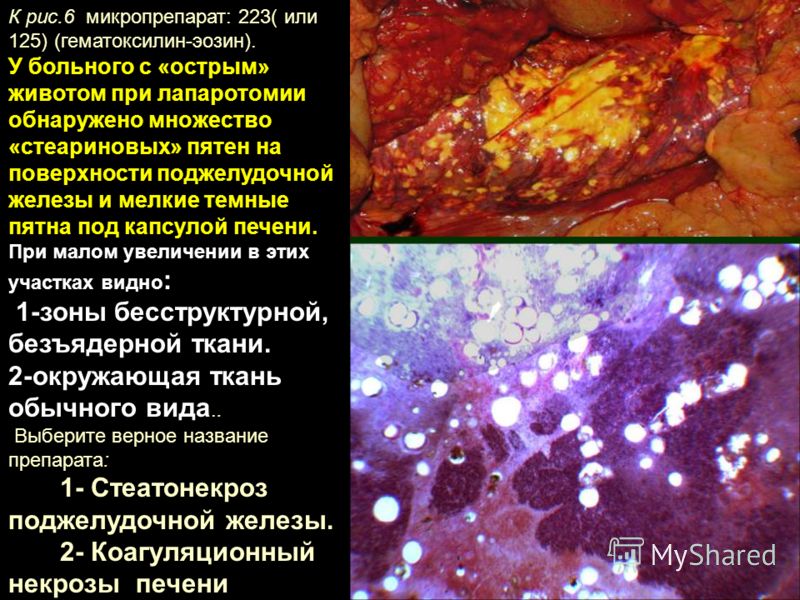 К рис.6 микропрепарат: 223( или 125) (гематоксилин-эозин). У больного с «острым» животом при лапаротомии обнаружено множество «стеариновых» пятен на поверхности поджелудочной железы и мелкие темные пятна под капсулой печени. При малом увеличении в эт