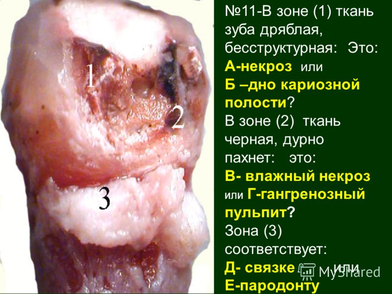 11-В зоне (1) ткань зуба дряблая, бесструктурная: Это: А-некроз или Б –дно кариозной полости? В зоне (2) ткань черная, дурно пахнет: это: В- влажный некроз или Г-гангренозный пульпит? Зона (3) соответствует: Д- связке или Е-пародонту