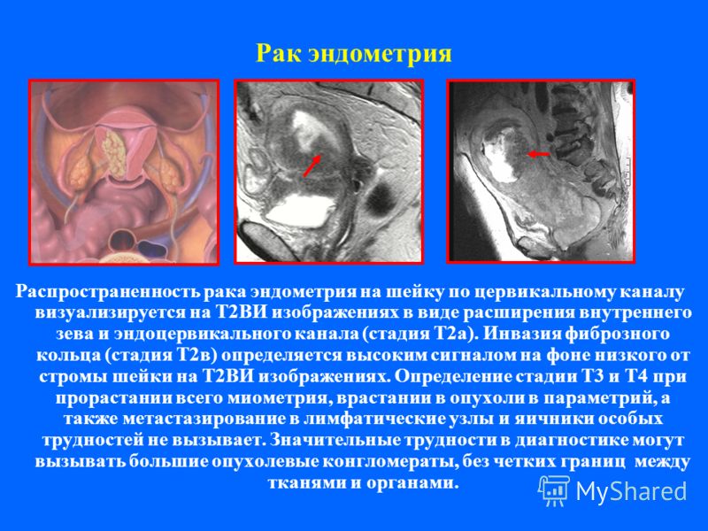 Рак эндометрия Распространенность рака эндометрия на шейку по цервикальному каналу визуализируется на Т2ВИ изображениях в виде расширения внутреннего зева и эндоцервикального канала (стадия Т2а). Инвазия фиброзного кольца (стадия Т2в) определяется вы