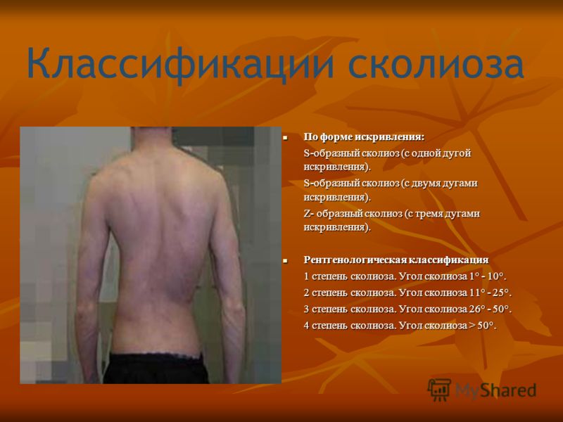Сколиоз 2 степени лечение в домашних условиях отзывы