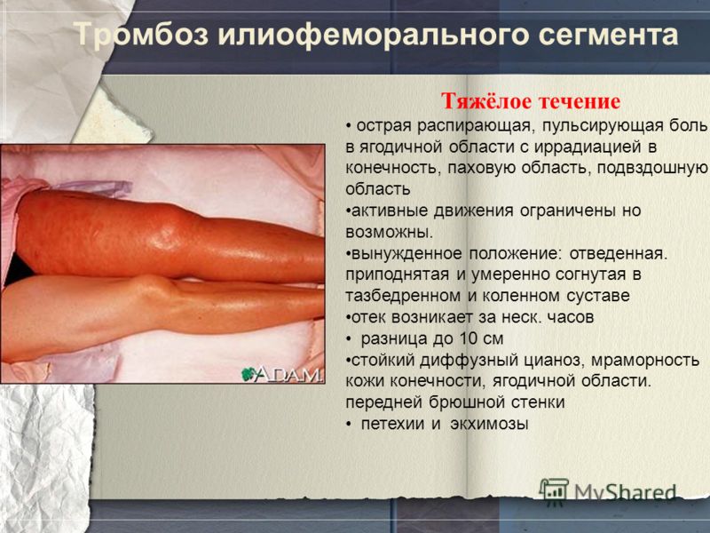 Реферат: Тромбоэмболия легочной артерии
