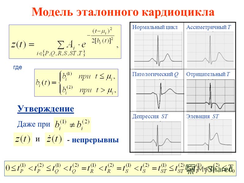 Модель эталонного кардиоцикла где Утверждение Даже при - непрерывны и Нормальный циклАссиметричный Т Патологический QОтрицательный T Депрессия STЭлевация ST