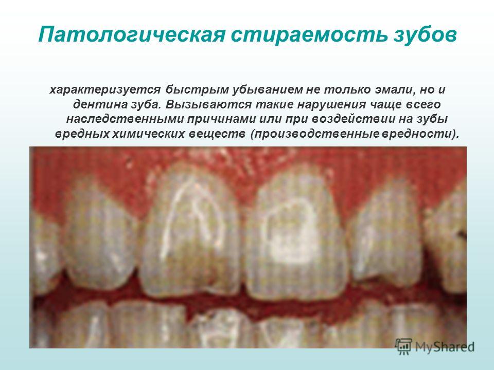 Профилактика стирание эмали зубов Профилактика стирание эмали зубов