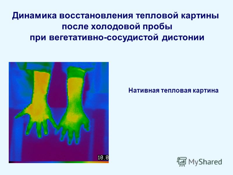 Динамика восстановления тепловой картины после холодовой пробы при вегетативно-сосудистой дистонии Нативная тепловая картина