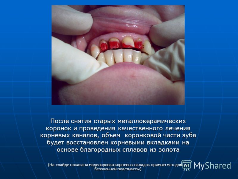 Будут снимать коронку с зуба Будут снимать коронку с зуба