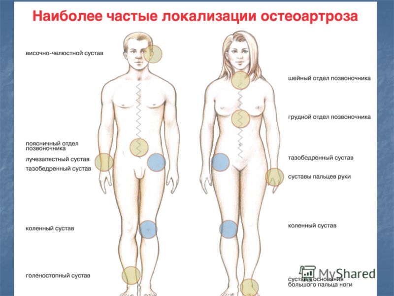 Заболевание доа суставов Заболевание доа суставов