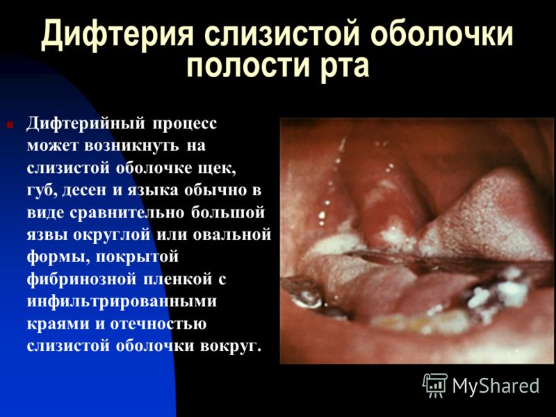 Дифтерия слизистой оболочки полости рта Дифтерийный процесс может возникнуть на слизистой оболочке щек, губ, десен и языка обычно в виде сравнительно большой язвы округлой или овальной формы, покрытой фибринозной пленкой с инфильтрированными краями и