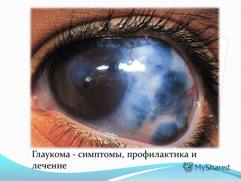 Глаукома - симптомы, профилактика и лечение